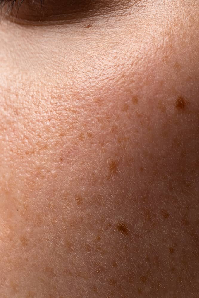 Acne & Scars